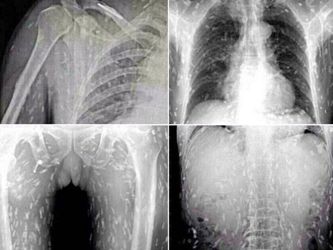 xray of a mans body infested with parasites after eating sushi